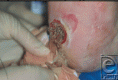 /album/galeria-de-fotos%3a-doen%c3%a7as/eplasty11e033-fig1-gif/